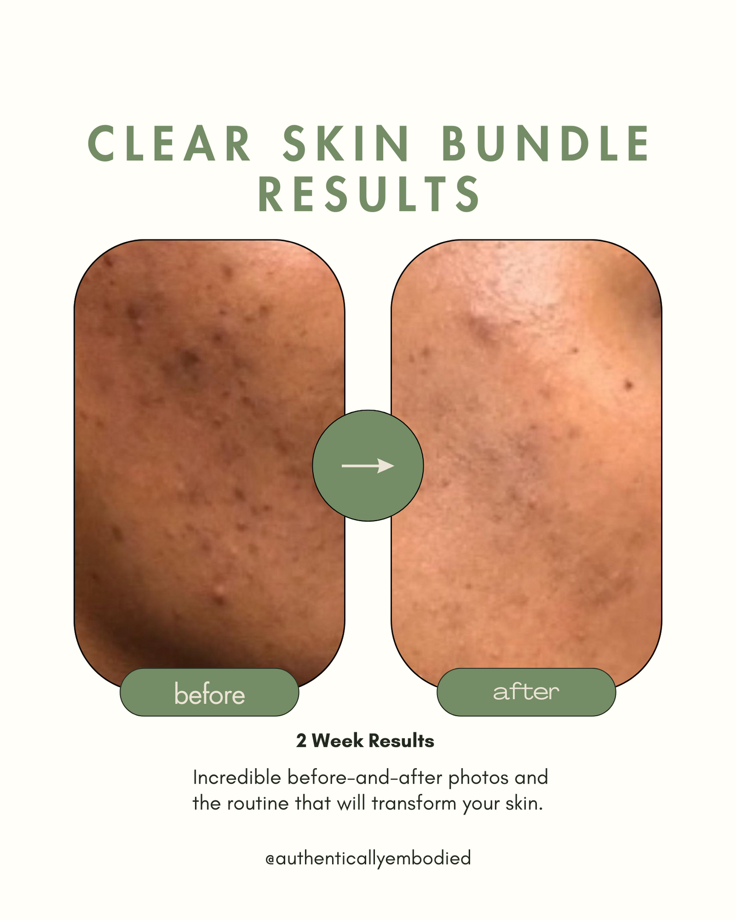 Clear Skin Bundle