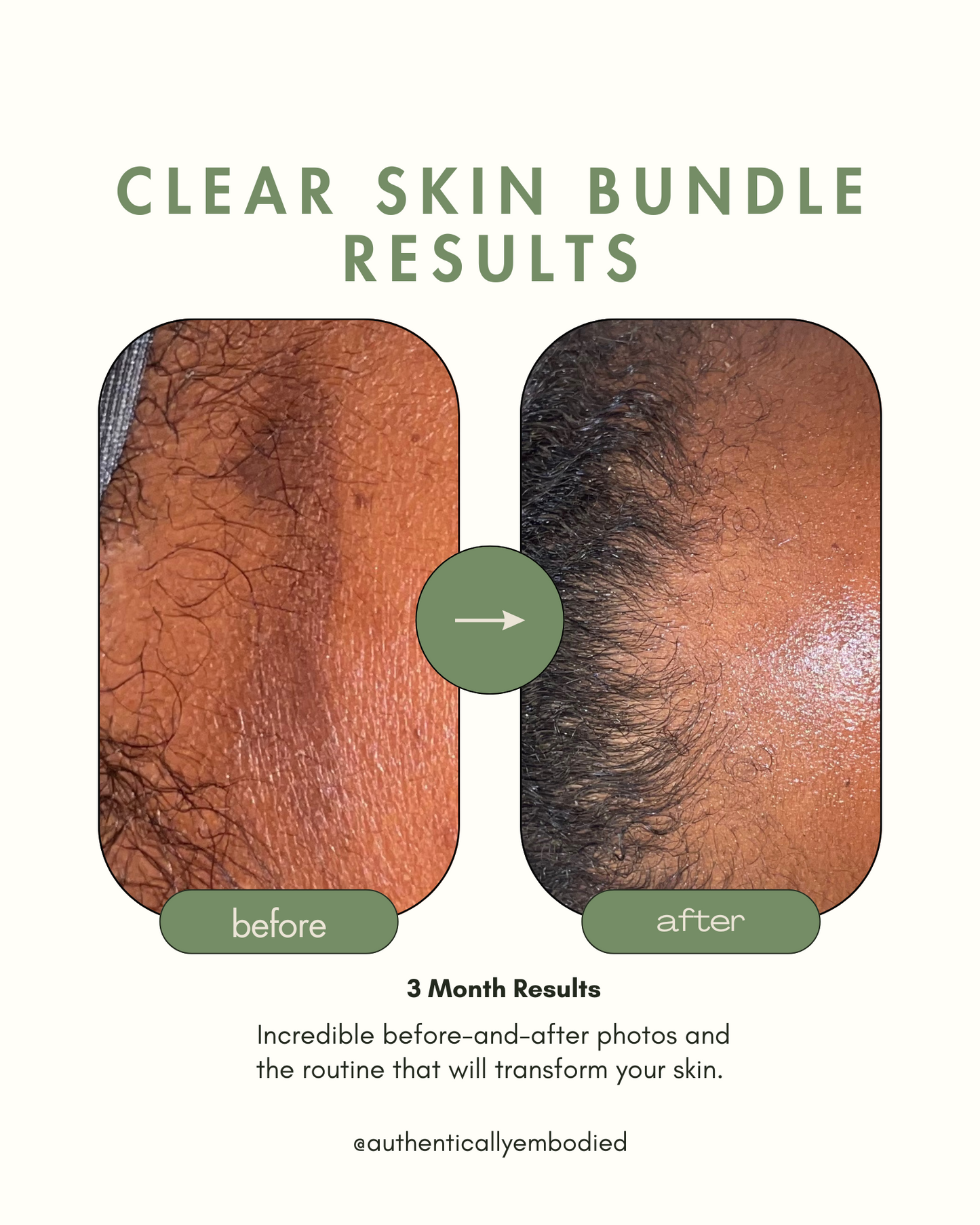 Clear Skin Bundle